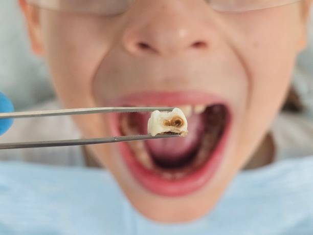 Best Emergency Tooth Extraction in Burlington, WI
